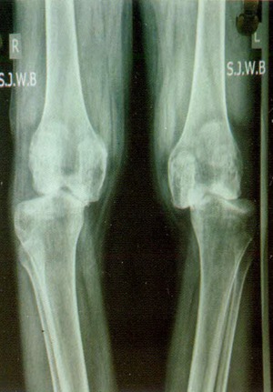 Damaged Knee