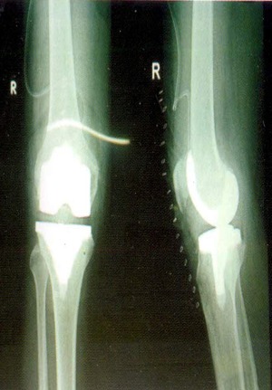 recovered knee after operation