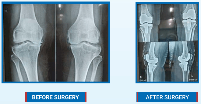 inside view of knee before and after surgery