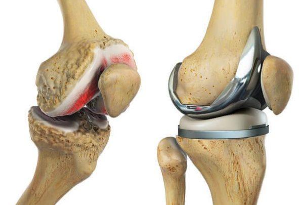 Revision Total Joint Replacement in pune
