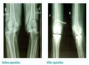 Difference between Damaged Knee and recovery knee after robotic surgery