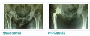 Before and After Hip Replacement surgery pictures
