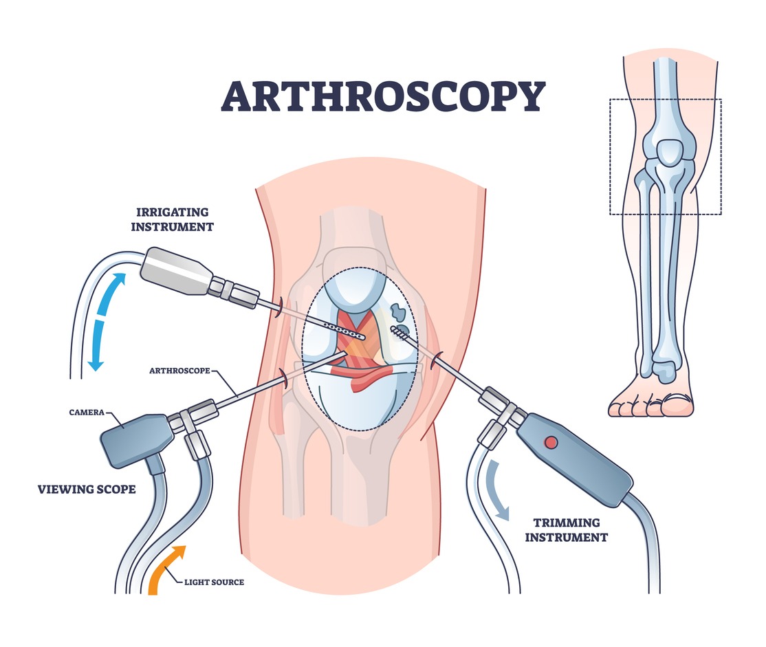 Arthroscopy Surgery in Pune