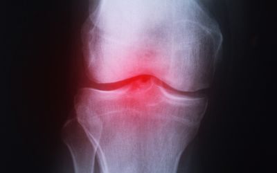 What are the Common Causes of Knee Pain? - Dr. Murtaza Adeeb